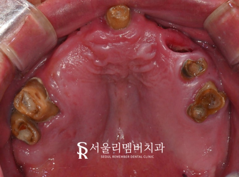 앞니 송곳니 어금니 윗니 전체 임플란트 성공 케이스 "서울대입구역 치과" 관련 이미지 1