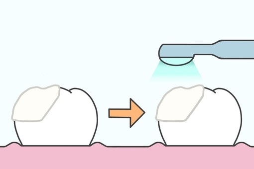 봉천역 치과 어금니 깨짐 당일 레진 치료 되는 곳, 자연스러운 외관 회복 관련 이미지 2