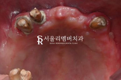 전체 보철을 할 수 밖에 없었던 이유, 서울대입구역 치과 교합 되살리기 관련 이미지 2
