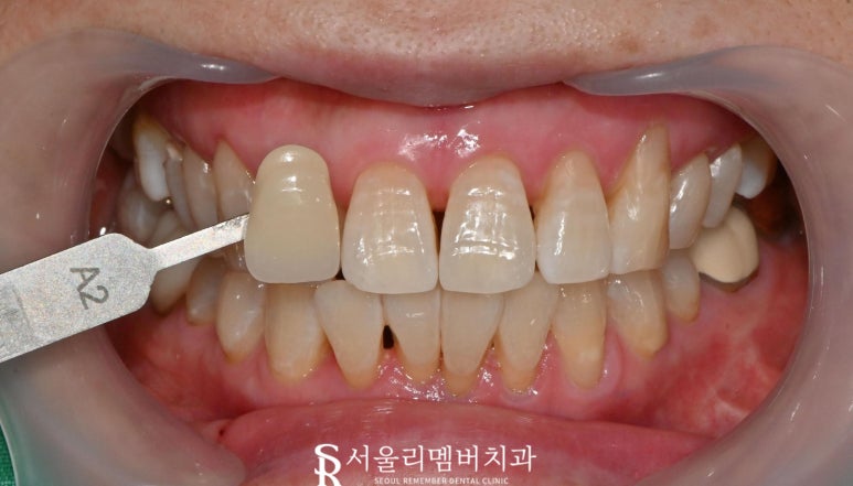 누런이가 고민이신가요? 신대방 치과 에서 전문가 치아 미백 과정 관련 이미지 3