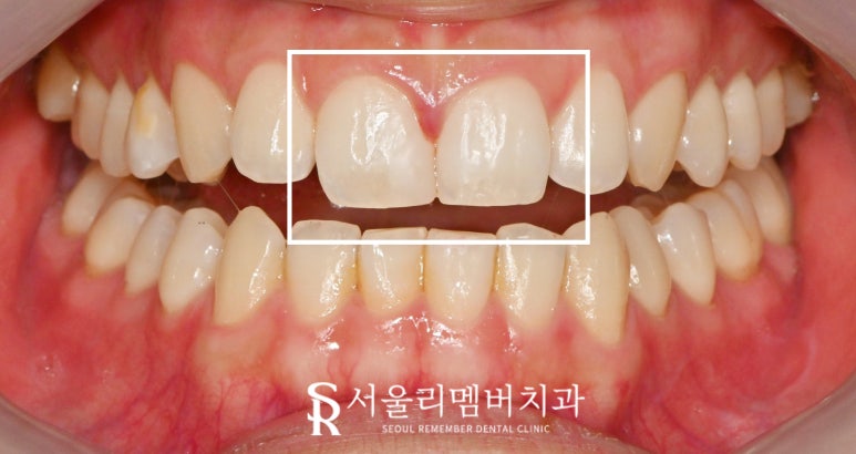 서울대입구역 치과 벌어진 앞니, 다이아스태마 레진 당일 치료 과정 관련 이미지 2