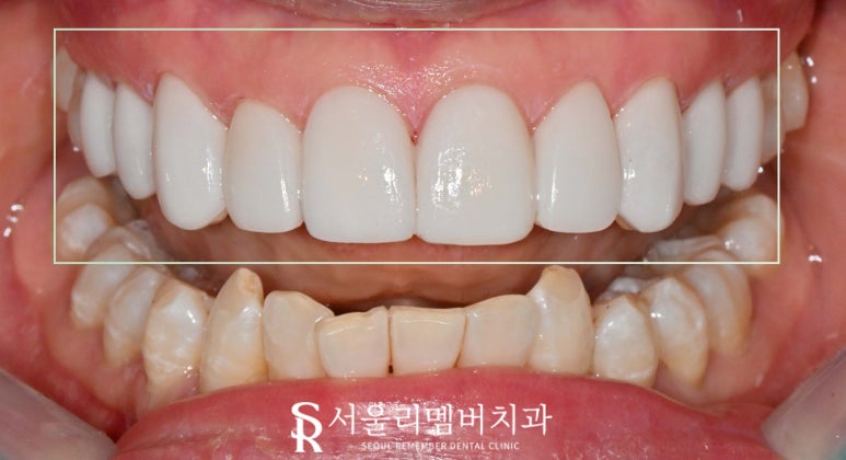 앞니 탈회 초기 충치 절단연 깨짐 치아 길이 안맞음 서울대입구 치과 전치부 리얼네이트 치료 과정 관련 이미지 6