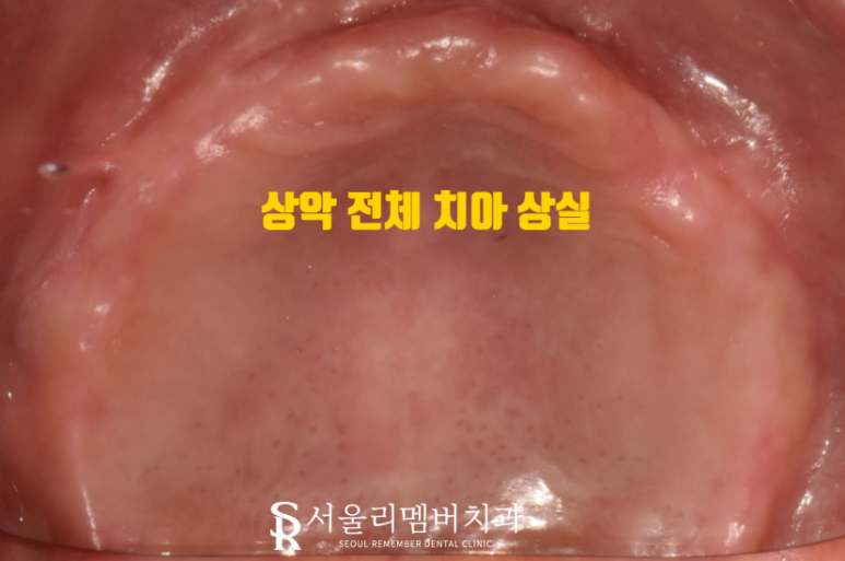 오랜 틀니 착용으로 잇몸이 다 망가졌던 분.. 임플란트 식립으로 밝은 미소 되찾아드렸습니다! 서울대입구역 서울 리멤버 치과 관련 이미지 1