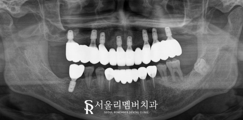 치아 빠지고 흔들리는 어금니와 치주 질환으로 통증 생긴 구강, 관악구 치과 상악 전체 임플란트 및 하악 신경치료 크라운 진행 과정 관련 이미지 9