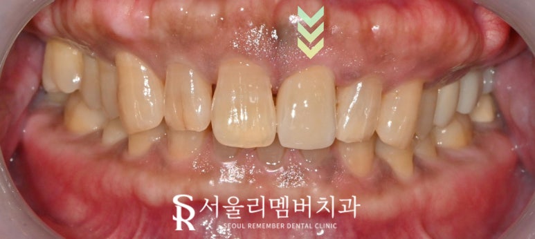 앞니가 깨졌다면? 상도동 치과 신경치료 없이 크라운만으로 자연치아 살리기 관련 이미지 3