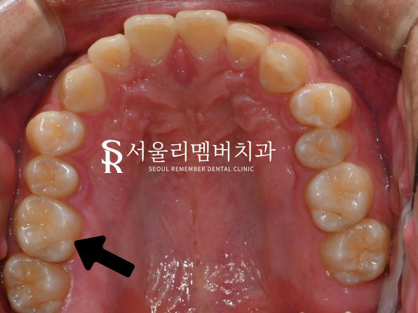 사당동 리멤버 치과 에서 어금니 이시림을 인레이로 개선해 드렸습니다. 관련 이미지 2