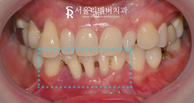 치주염으로 아래 앞니 흔들린다면? 신대방 치과 임플란트 브릿지 치료로 해결 관련 이미지 1