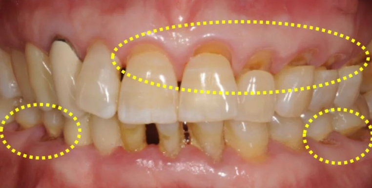 예쁜 미소를 되찾는 순간 낙성대 치과 전악 보철을 통한 치아 심미성 회복의 놀라운 변화 관련 이미지 2