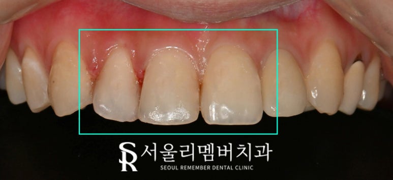 낙성대역 치과 오래된 앞니 레진 변색 및 착색되어 재치료 필요하다면? 관련 이미지 2