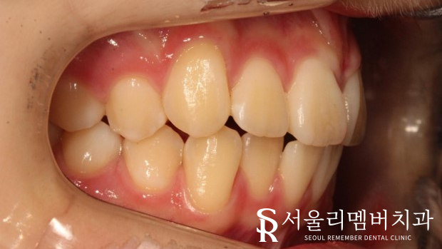 인비절라인을 사용한 치아 총생 개선 증례! 청룡동 치과 관련 이미지 1