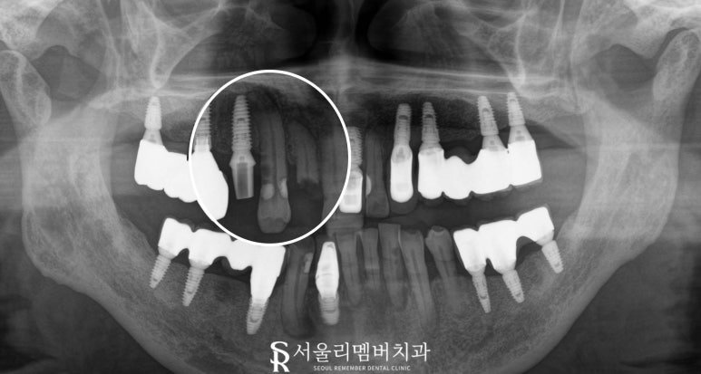 앞니 깨짐 및 충치, 임플란트 크라운 탈락 시 빠른 치료가 중요한 이유 서울대입구역 치과 관련 이미지 2