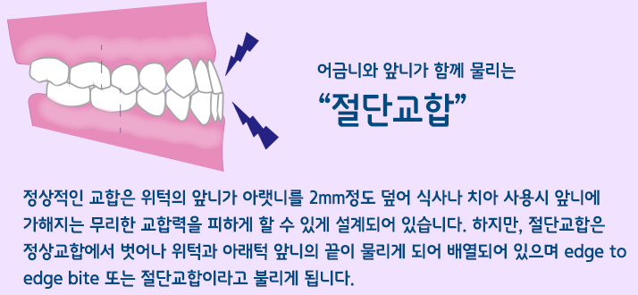 신림 치과 깨지고 길이 안 맞는 앞니 부러진 부분만 레진으로 간단하게 당일 치료 관련 이미지 3