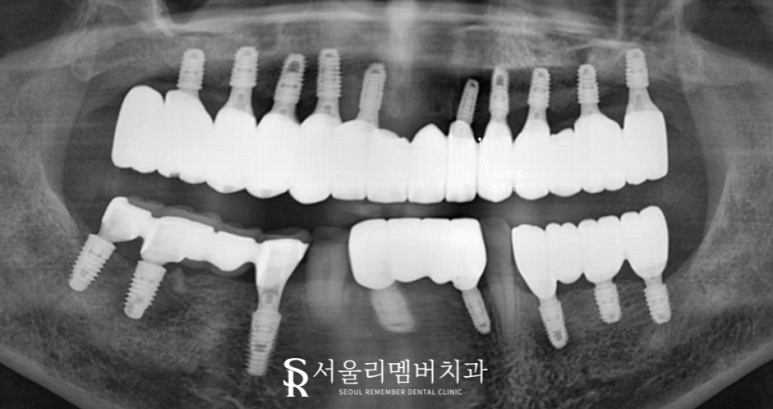 전에 씌워놨던 크라운에서 통증이 느껴져요.. 도대체 왜 그런 거죠? 서울대입구역 서울 리멤버 치과 관련 이미지 7