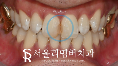 변색된 앞니 레진, 티 안 나게 교체할 수 있을까요? 서울대입구역치과 관련 이미지 1