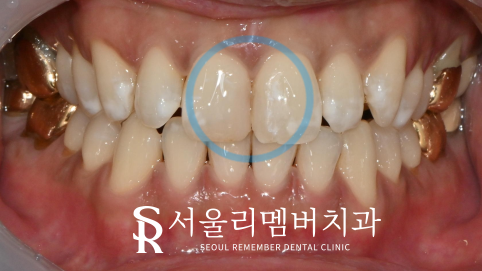 변색된 앞니 레진, 티 안 나게 교체할 수 있을까요? 서울대입구역치과 관련 이미지 2