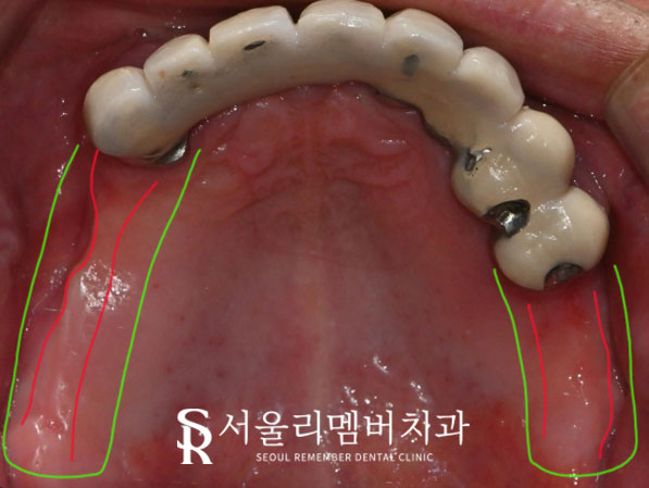 서울대입구역 치과 , 잇몸뼈 부족해도 전체 임플란트 ? 가능합니다. <증례 有> 관련 이미지 1
