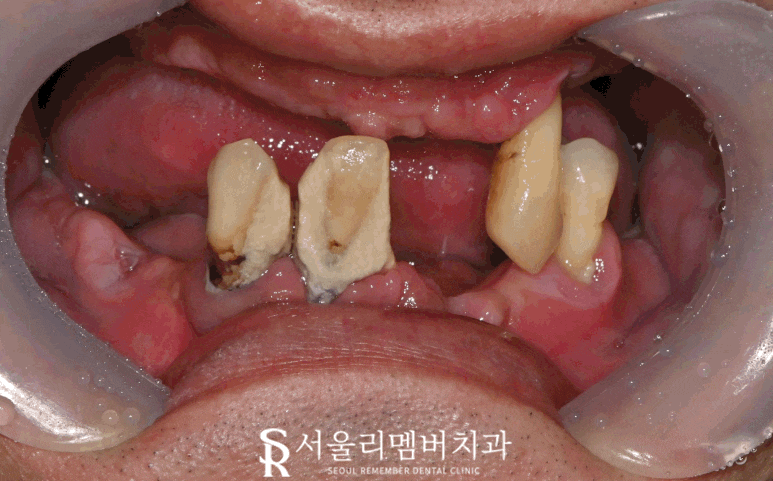 신대방 치과 에서 전악 수면마취 임플란트 수술로 전체 치아 회복시켜드렸습니다. 관련 이미지 1