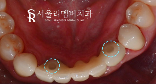 서울대입구역치과 에서 아래 앞니 5개를 임플란트 2개만으로 자연스럽게 회복 관련 이미지 7