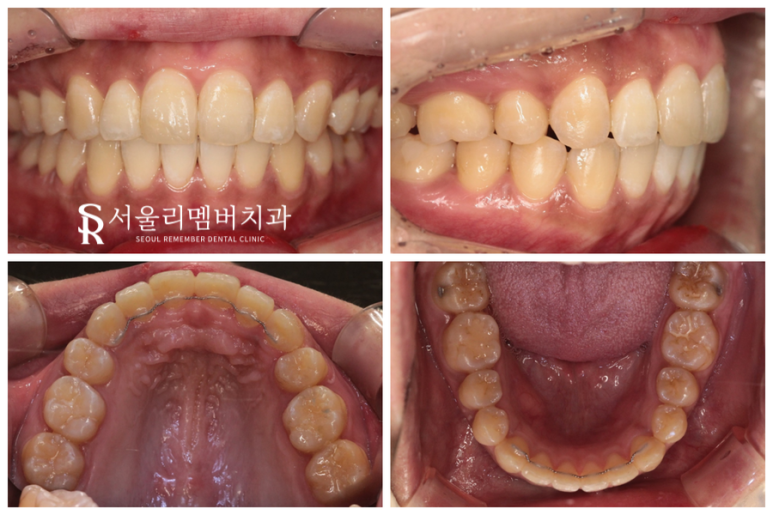 입이 툭 튀어나온 2급 부정교합, 서울대입구치과 발치 교정 증례 관련 이미지 2