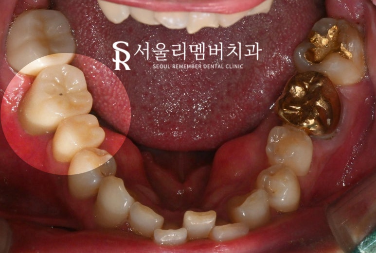 치아 깨지고 통증 있을 때, 서울대입구역 치과 파절 정도에 따른 신경치료 크라운 및 발치 임플란트 관련 이미지 7