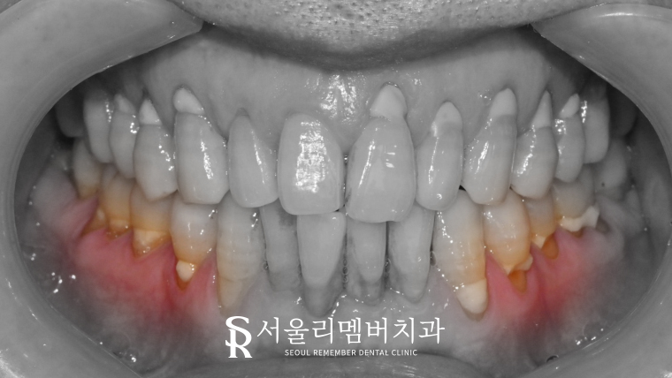 치경부 마모증, 상도동 치과 에서는 어떻게 치료할까? 관련 이미지 1