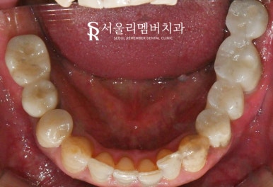 한 번에 많은 치아 치료해야 된다면? 사당역 치과 수면 임플란트 로 편안하게 관련 이미지 8