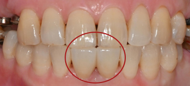 보라매역 치과 신경치료 및 크라운으로 기능과 외관 되살리기. 관련 이미지 7