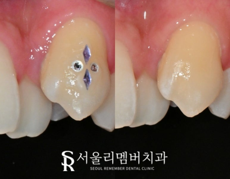 상도동 치과 송곳니 투스잼과 잔여 레진, 안전하고 스크래치 기스 흠집 없이 당일 제거할 수 있을까? 관련 이미지 3