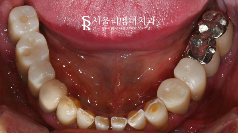 임플란트 및 크라운 으로 구강 환경 개선하는 방법 - 서울대입구역 치과 관련 이미지 5