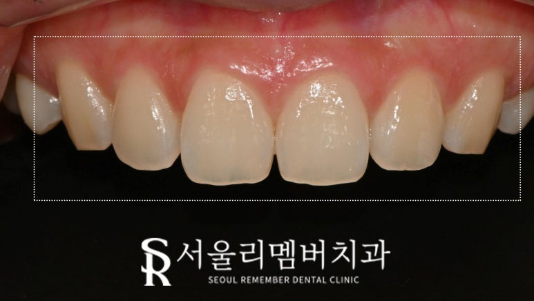 서울대입구역 치과 결혼 앞둔 예비 신부 주목! 누런 앞니, 모양 마음에 들지 않는다면 무삭제 라미네이트로 해결 관련 이미지 1