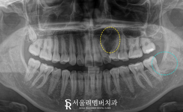 서울대입구 치과 에서 숨어있는 견치 와 매복 사랑니 까지 한 번에 안 아프게 뽑아드렸습니다. 관련 이미지 3