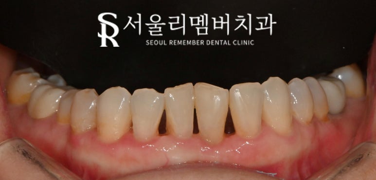 Restore a Natural, Even Smile with No-Prep Realnate! Laminate Veneers for Front Teeth at a Seoul National University Entrance Station Dental Clinic image 3