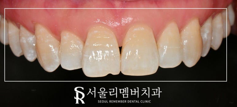 앞니 탈회 초기 충치 절단연 깨짐 치아 길이 안맞음 서울대입구 치과 전치부 리얼네이트 치료 과정 관련 이미지 3
