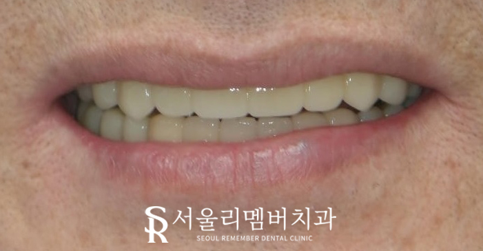 과잉진료 없는 보라매 치과 에서 최소 개수 전악 임플란트 식립 관련 이미지 9