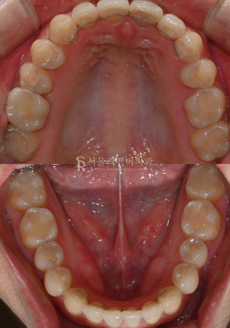 A “Pop-Out” Tooth, Cavities in the Front Teeth and Molars: Orthodontic and Cavity Treatment at a Sindae-bang Dental Clinic image 6