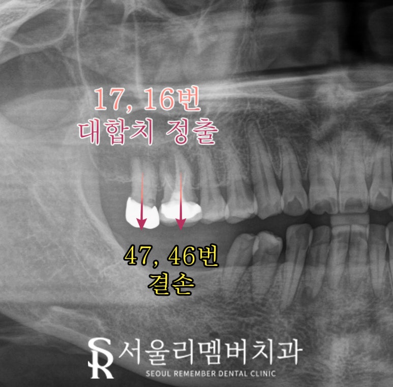 봉천역 치과 어금니 보철 후 음식물 끼임 및 치아 파절, 신경치료 크라운 및 임플란트 관련 이미지 4