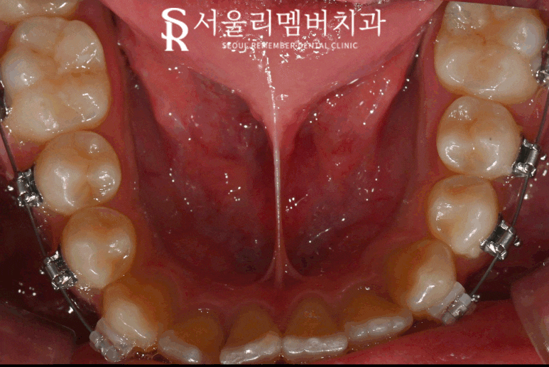 혀가 짧다? 설소대 절제술로 해결할 수 있습니다. 봉천동 치과 관련 이미지 3