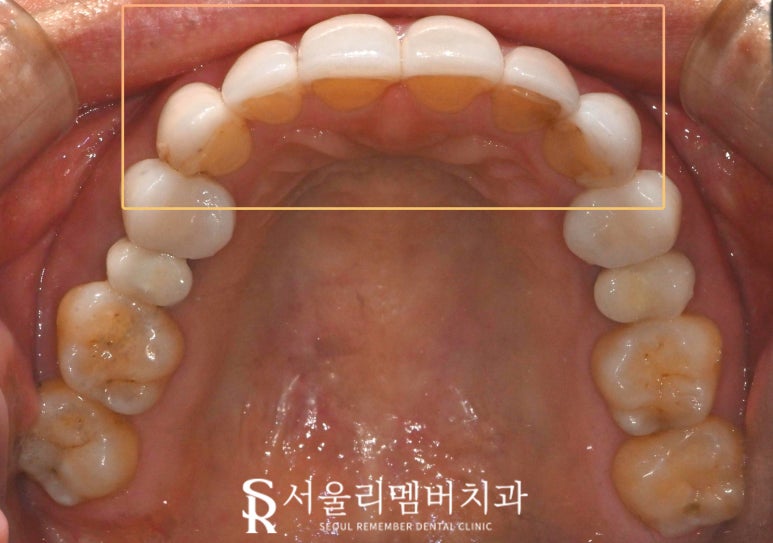 기존 라미네이트 보철 변색 및 송곳니 파절 안쪽으로 이차 우식 생겼을 때 신림역 치과 수면으로 충치치료 리얼네이트 당일 진료 가능할까 관련 이미지 5