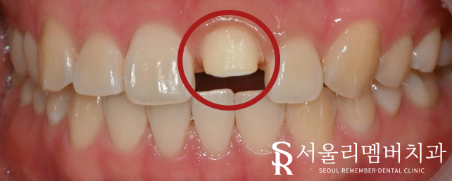 신길동 치과 부러진 앞니, 신경치료로 티 안 나게 개선 완료! 관련 이미지 6