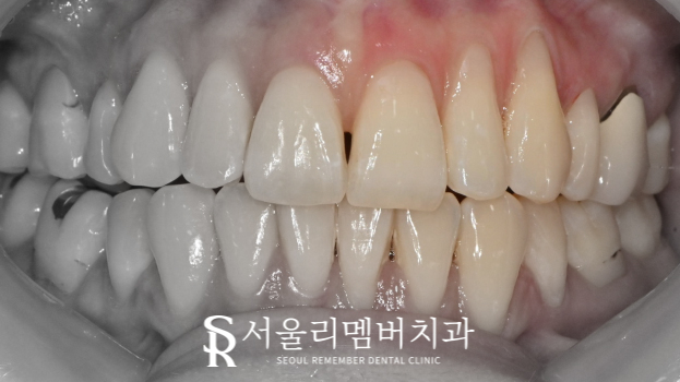 "잇몸이 점점 드러나는 느낌이 들어요." 서울대입구역치과 당일 레진 치료 관련 이미지 2