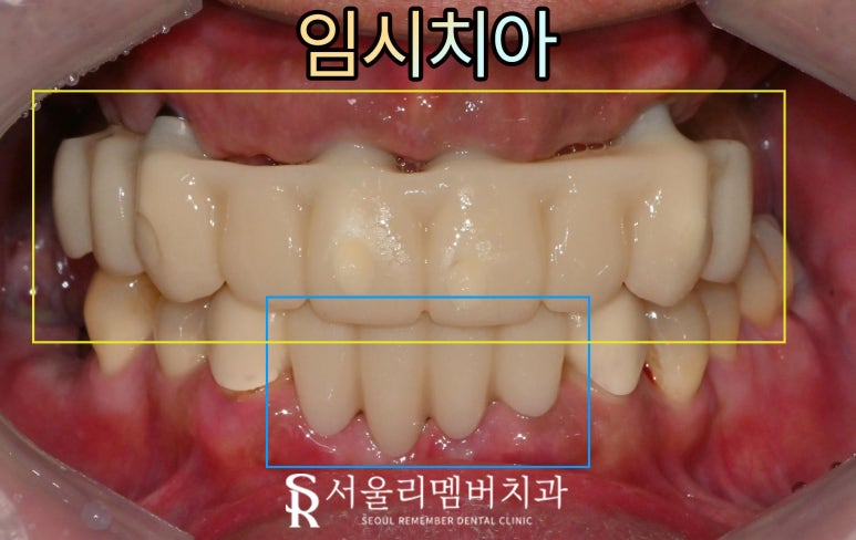 치아 빠지고 흔들리는 어금니와 치주 질환으로 통증 생긴 구강, 관악구 치과 상악 전체 임플란트 및 하악 신경치료 크라운 진행 과정 관련 이미지 5