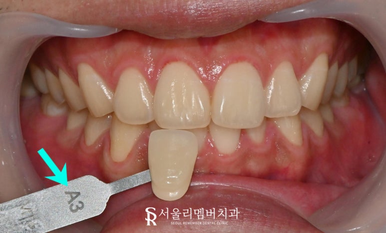 신대방 치과 치아미백 잘하는 곳 추천, 오래 유지하려면 어떻게 해야 되나요? 관련 이미지 2