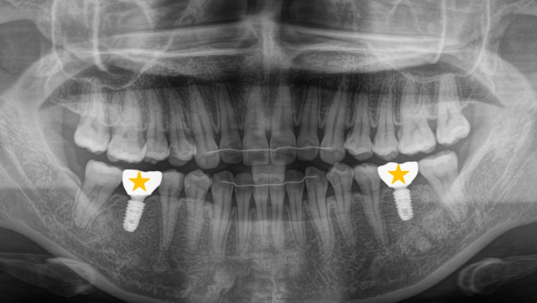 선천적 영구치 결손으로 남아있는 만기 잔존 유치, 서울대입구역 교정 치과 에서 투명 인비절라인 & 임플란트 케이스 관련 이미지 8