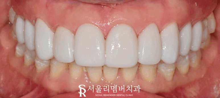 앞니 탈회 초기 충치 절단연 깨짐 치아 길이 안맞음 서울대입구 치과 전치부 리얼네이트 치료 과정 관련 이미지 4