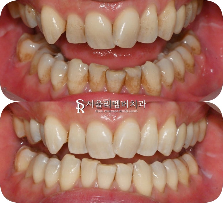 신림역 치과 스케일링 치석제거로 착색과 변색 해결하면 치아미백 만큼 하애질 수 있을까? 관련 이미지 5