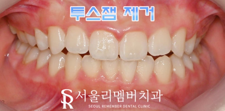 서울대입구역 치과 투스잼 제거 꼭 전문가에게 해야 되는 이유와 관리 방법 관련 이미지 3