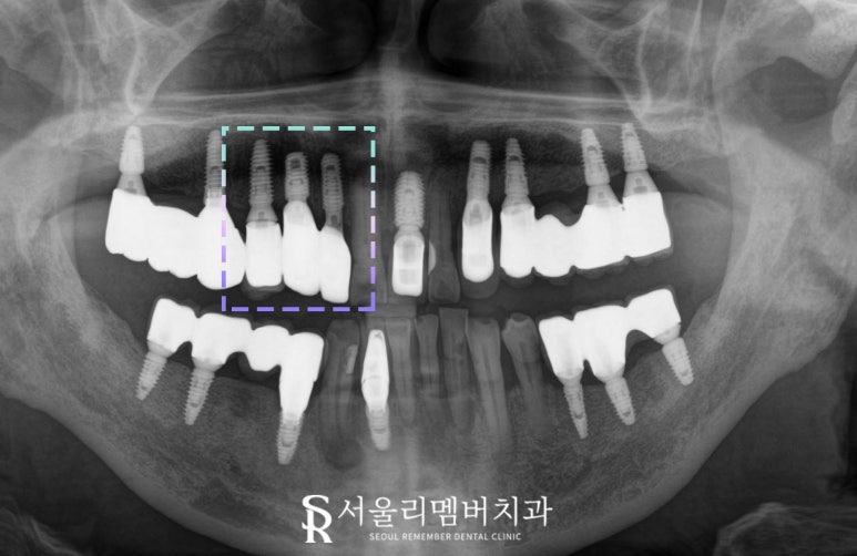 앞니 깨짐 및 충치, 임플란트 크라운 탈락 시 빠른 치료가 중요한 이유 서울대입구역 치과 관련 이미지 4