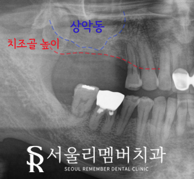 봉천동 치과 임플란트 치료 과정, 어금니가 없어서 식사가 어려워요. 관련 이미지 4
