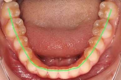 조기접촉 교정 후 관련 이미지 5