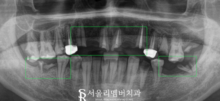 믿고 맡길 수 있는 신대방 치과 전체 임플란트 관련 이미지 1